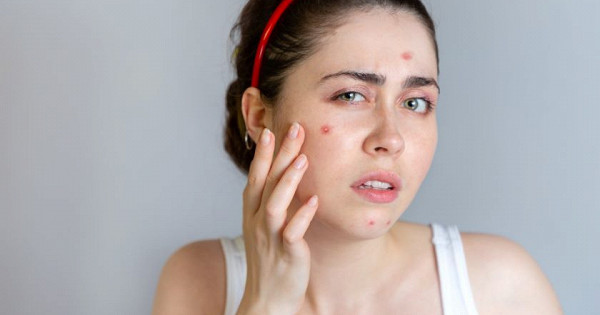 6 главных вопросов о подростковых прыщах, которые волнуют всех родителей