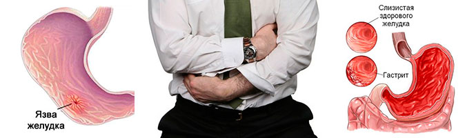 Современное лечение гастрита и язвы
