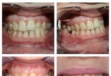 Брекеты в Краснодаре