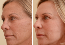 Методика фракционного RF-лифтинга Fractora