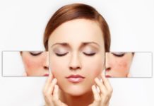 Как избавиться от купероза на лице