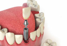 Современные технологии в имплантации зубов