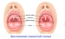 Как быстро убрать першение в горле? Нашли средство, которое работает