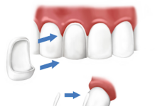 Способы установки виниров