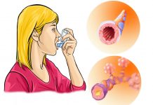 Как оказать первую помощь при бронхоспазме?