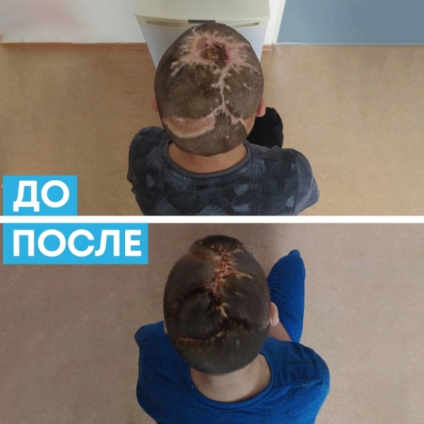Челябинский хирург восстановил волосы оскальпированному собаками мальчику