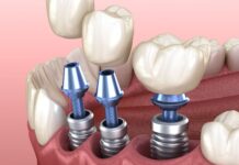 Критерии выбора зубных имплантов