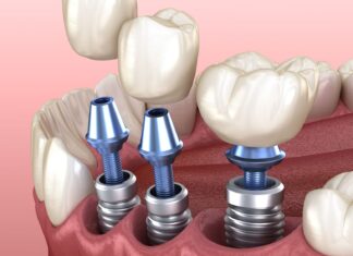 Критерии выбора зубных имплантов